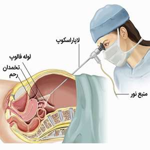 لاپاراسکوپی